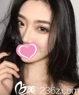 做假體隆鼻術(shù)后一個月時<span style=