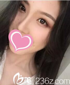 永州博美整形醫(yī)院怎么樣？看我找做的假體隆鼻術(shù)后三個月恢復(fù)效果！