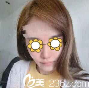 自體脂肪填充面部術(shù)后<span style=