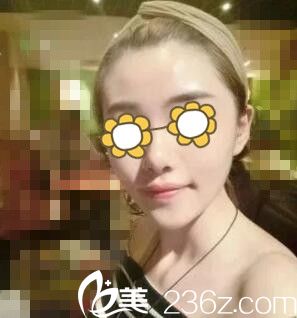 在永州博美做自體脂肪填充全臉術(shù)后一周<span style=