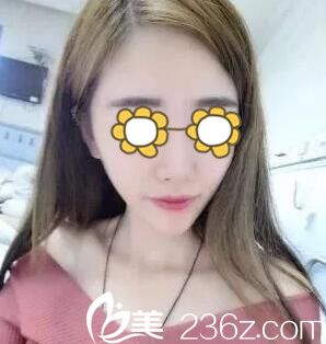 真人案例：永州博美整形美容醫(yī)院自體脂肪填充面部恢復(fù)全過程前后對比照片分享