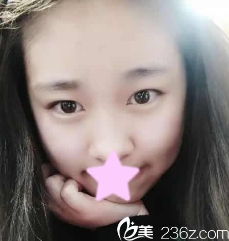 我在運(yùn)城麗都整形醫(yī)院做雙眼皮修復(fù)前的照片 我在運(yùn)城麗都整形醫(yī)院做雙眼皮修復(fù)前的照片