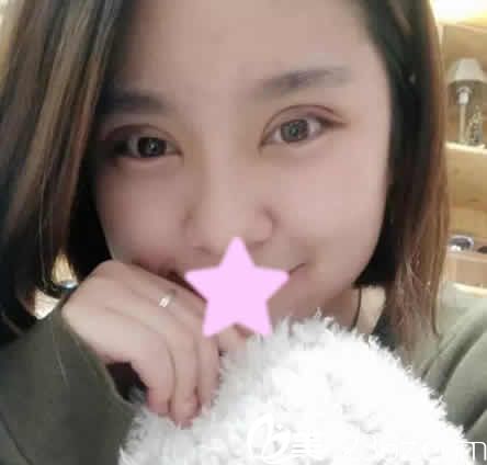 我在運(yùn)城麗都做切開(kāi)雙眼皮修復(fù)和開(kāi)眼角后第7天照片 我在運(yùn)城麗都做切開(kāi)雙眼皮修復(fù)和開(kāi)眼角后第7天照片