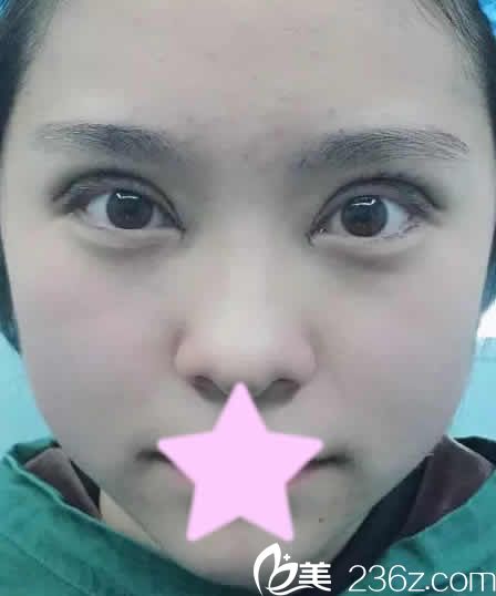 我在運(yùn)城麗都做全切雙眼皮修復(fù)加開(kāi)眼角后第3天照片 我在運(yùn)城麗都做全切雙眼皮修復(fù)加開(kāi)眼角后第3天照片