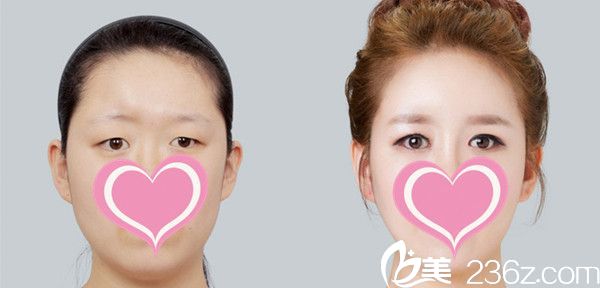 眼部整形案例