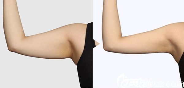 吸脂手術(shù)案例