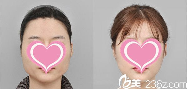 面部輪廓手術(shù)對(duì)比效果