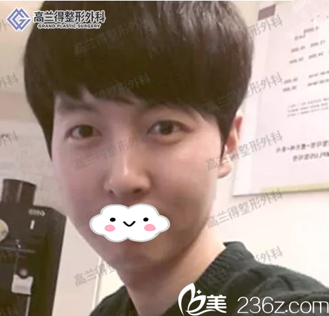 韓國(guó)高蘭得整形外科雙眼皮+鼻部整形+脂肪填充真人案例，手術(shù)一個(gè)月前后對(duì)比