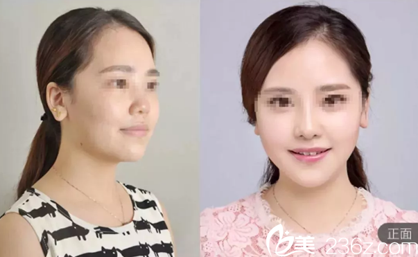 張家口維多利亞鼻綜合案例 張家口維多利亞鼻綜合案例