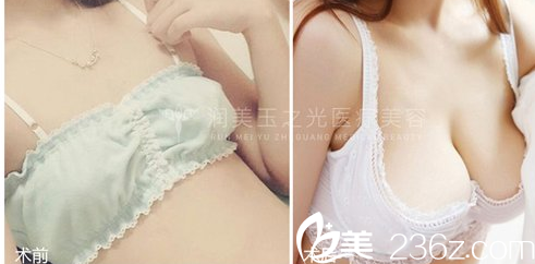 北京潤美玉之光朱金成自體脂肪豐胸案例