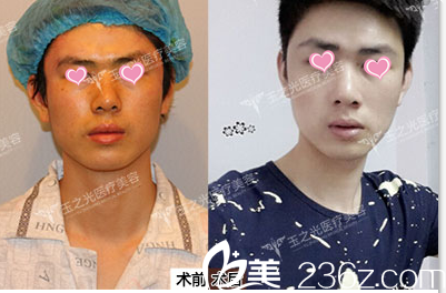 北京潤美玉之光朱金成自體脂肪面部填充案例