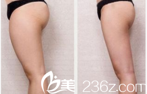 北京潤美玉之光朱金成吸脂瘦腿部案例