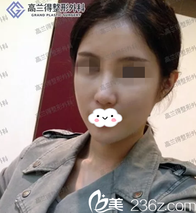 經(jīng)過(guò)韓國(guó)id和韓國(guó)高蘭得對(duì)比，較終還是選擇了高蘭得做面部輪廓整形，看我的術(shù)后三個(gè)月的恢復(fù)效果
