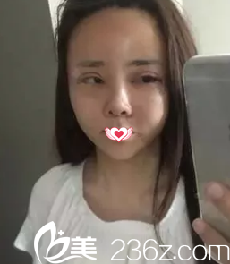 剛做完眼鼻綜合面部腫脹