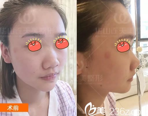 在杭州連天美做隆鼻前 在杭州連天美做隆鼻前