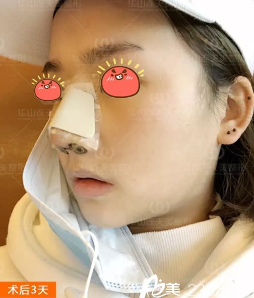 做完肋軟骨隆鼻3天恢復(fù)照 做完肋軟骨隆鼻3天恢復(fù)照