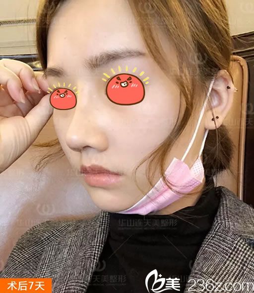 做完肋軟骨鼻綜合隆鼻7天效果圖 做完肋軟骨鼻綜合隆鼻7天效果圖