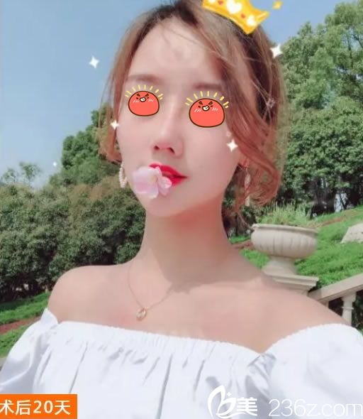 杭州連天美<!--<i data=20240703-sp></i>-->隆鼻案例20天效果 杭州連天美<!--<i data=20240703-sp></i>-->隆鼻案例20天效果