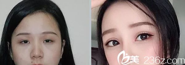 呼和浩特京美近視眼割雙眼皮案例