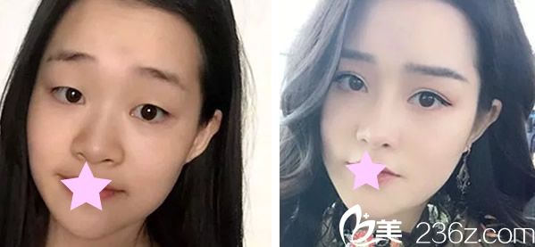 呼市伊思全切雙眼皮+開眼角兩個月效果對比