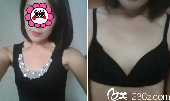 在長(zhǎng)春艾爾莎做假體隆胸手術(shù)前 在長(zhǎng)春艾爾莎做假體隆胸手術(shù)前