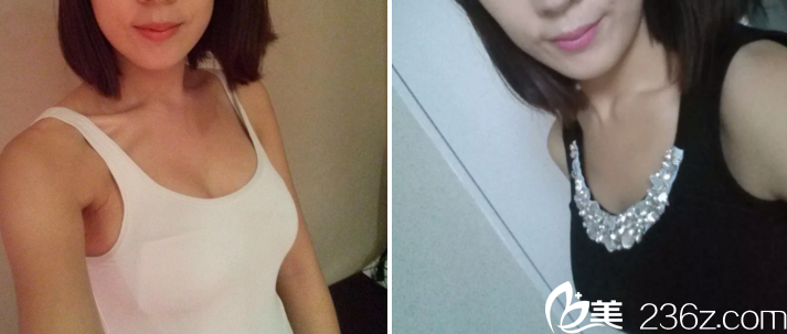 在長(zhǎng)春艾爾莎做假體隆胸手術(shù)后7天 在長(zhǎng)春艾爾莎做假體隆胸手術(shù)后7天