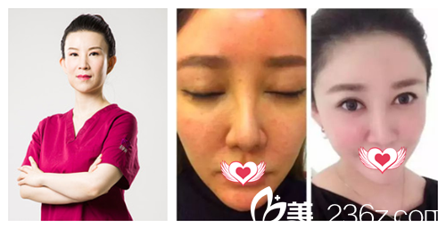 石家莊天伊美張斌醫(yī)生做激光祛斑案例 石家莊天伊美張斌醫(yī)生做激光祛斑案例