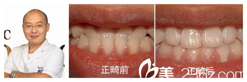 天伊美主任李功做正畸矯正案例 天伊美主任李功做正畸矯正案例