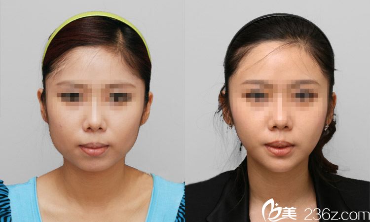 趙彥光主任注射瘦臉案例 趙彥光主任注射瘦臉案例