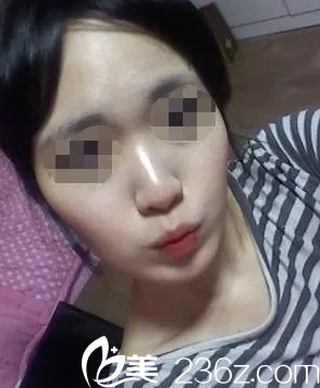 隆鼻手術(shù)前