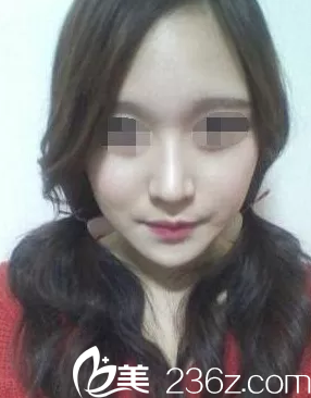 隆鼻手術(shù)一個(gè)月后