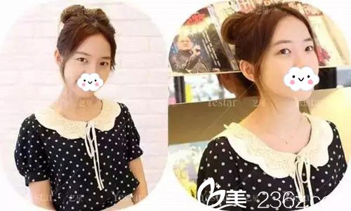 術(shù)前單眼皮+腫泡眼 術(shù)前單眼皮+腫泡眼