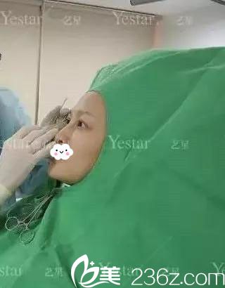 做雙眼皮術(shù)前劃線設(shè)計 做雙眼皮術(shù)前劃線設(shè)計