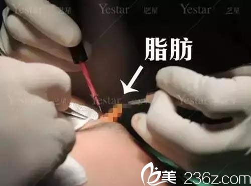 切開法雙眼皮去脂過程 切開法雙眼皮去脂過程