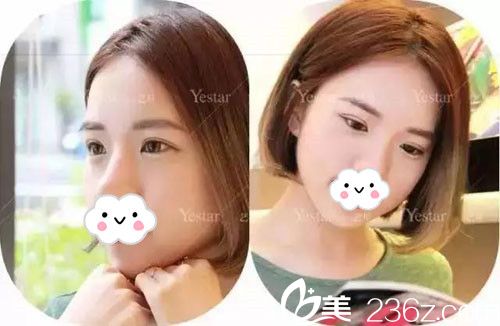 呂永全醫(yī)生切開法雙眼皮術(shù)后恢復(fù) 呂永全醫(yī)生切開法雙眼皮術(shù)后恢復(fù)