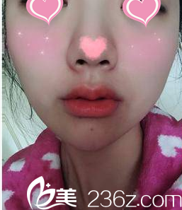 北京米蘭柏羽麗都梁春霞注射豐唇案例 北京米蘭柏羽麗都梁春霞注射豐唇案例