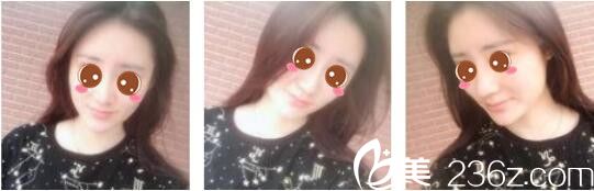 聽(tīng)說(shuō)樸帝泳做韓式隆鼻效果不錯(cuò)，看了韓國(guó)奧拉克鼻綜合和鼻修復(fù)的真人案例我信服了