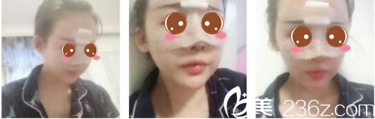 韓國(guó)奧拉克皮膚科整外科樸帝泳鼻修復(fù)真人案例術(shù)后第三天 韓國(guó)奧拉克皮膚科整外科樸帝泳鼻修復(fù)真人案例術(shù)后第三天