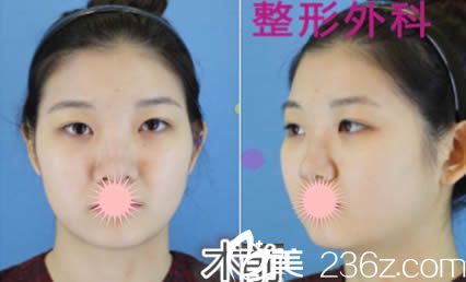 韓國GOODLINE崔德浩整形外科整形前照片 韓國GOODLINE崔德浩整形外科整形前照片