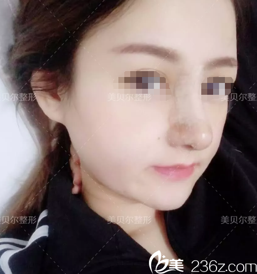 術(shù)后五天鼻綜合恢復(fù)中