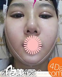 崔德浩院長給我做雙眼皮+假體隆鼻+面部輪廓4天后的照片 崔德浩院長給我做雙眼皮+假體隆鼻+面部輪廓4天后的照片