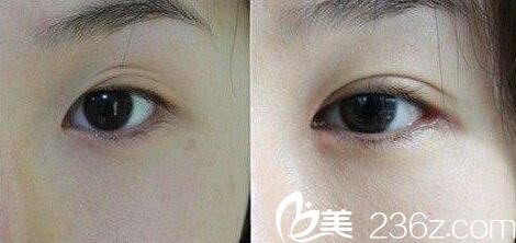 營口康藝整形醫(yī)院眼部真人案例