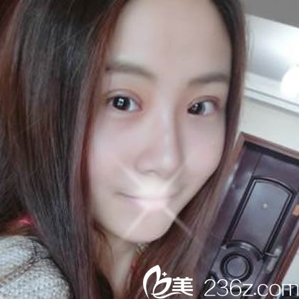 做完埋線雙眼皮10天恢復(fù)照 做完埋線雙眼皮10天恢復(fù)照