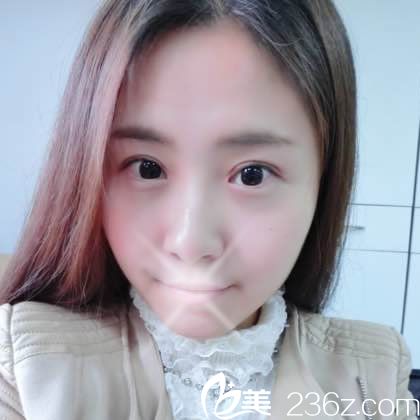 對不起,現(xiàn)在才來分享找溫州芘麗芙美容醫(yī)院金鋒做埋線雙眼皮的手術經(jīng)歷