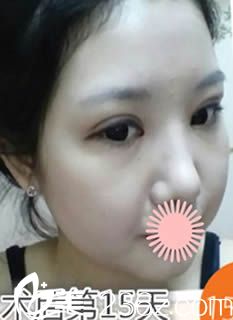 韓國GOODLINE崔德浩整形外科術(shù)后15天效果照 韓國GOODLINE崔德浩整形外科術(shù)后15天效果照