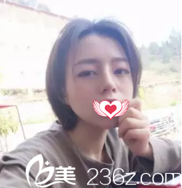 在廊坊艾美做硅膠隆鼻術(shù)后效果太自然 讓我忍不住想要分享下恢復(fù)25天的美照