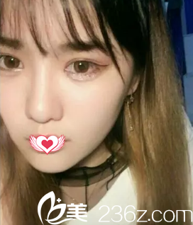 術后22天臉型變?yōu)榫滦臉 術后22天臉型變?yōu)榫滦臉