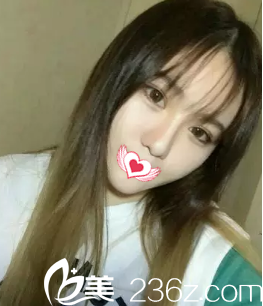 面部吸脂16天完全消腫 面部吸脂16天完全消腫