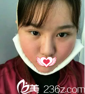 剛做完面部吸脂手術面部腫脹 剛做完面部吸脂手術面部腫脹