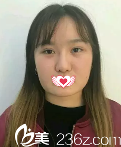 術前是大餅臉 術前是大餅臉